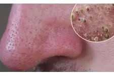 Burundaki Siyah Nokta Temizleme