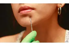 Siyah Nokta Çıkarma