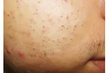 Siyah Nokta Nasıl Çıkarılır?