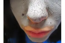 Siyah Nokta ve Gözenekler