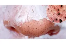 Tutkalla Siyah Nokta Uygulaması 