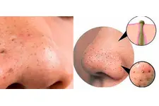 Yumurta Siyah Nokta Tarifi ve Malzemeleri