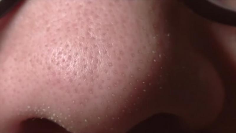 Burundaki Siyah Noktalar İçin Maske