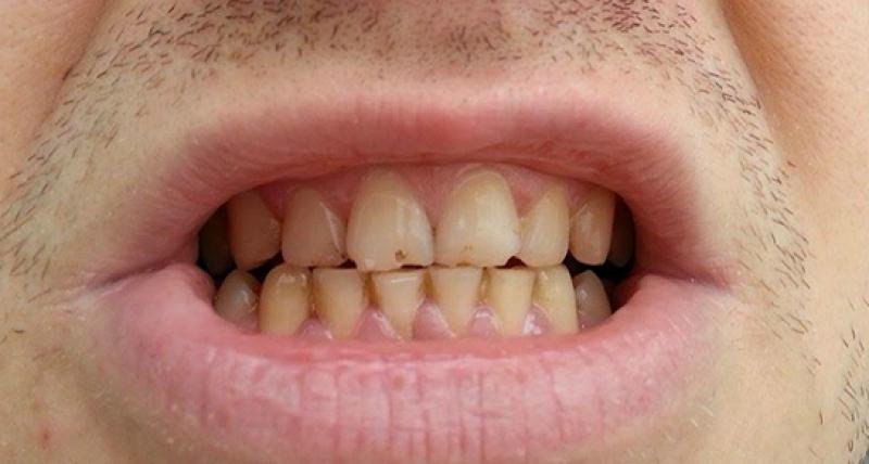 Dişte Siyah Nokta Belirtileri ve Tedavisi