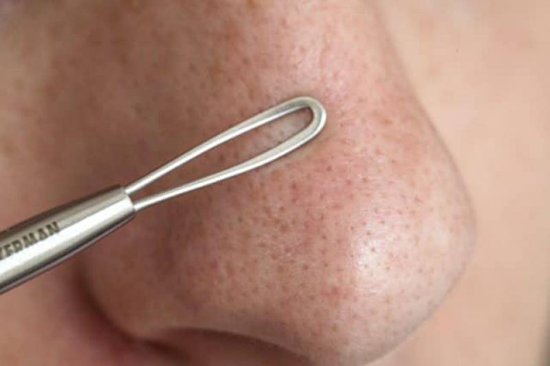 Jelatin Siyah Nokta Kullanımı ve Faydaları Nelerdir?