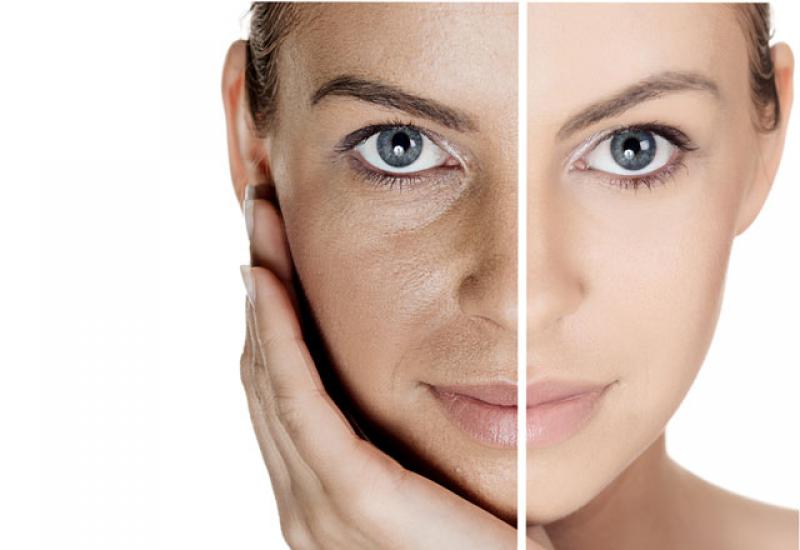 Lazerle Siyah Nokta Aldırma