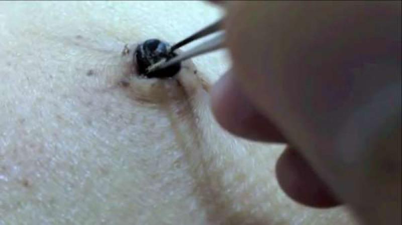 Siyah Nokta Ameliyatı ve Sonrası