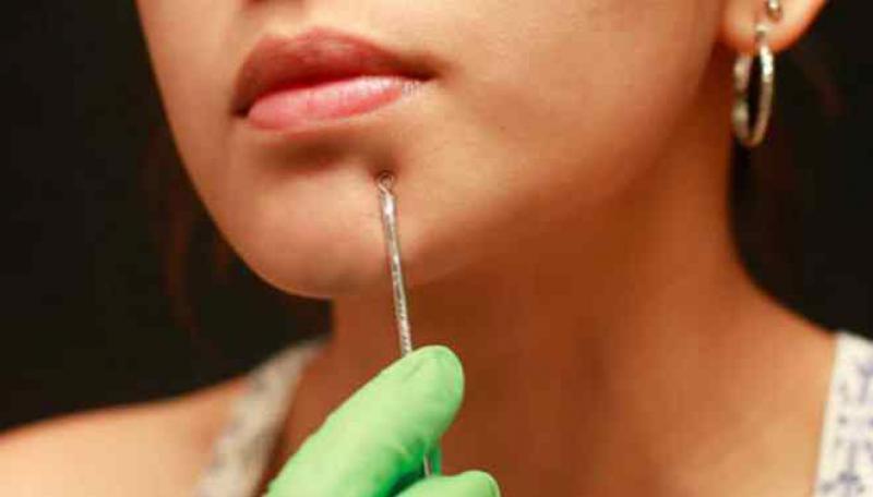 Siyah Nokta Çıkarma