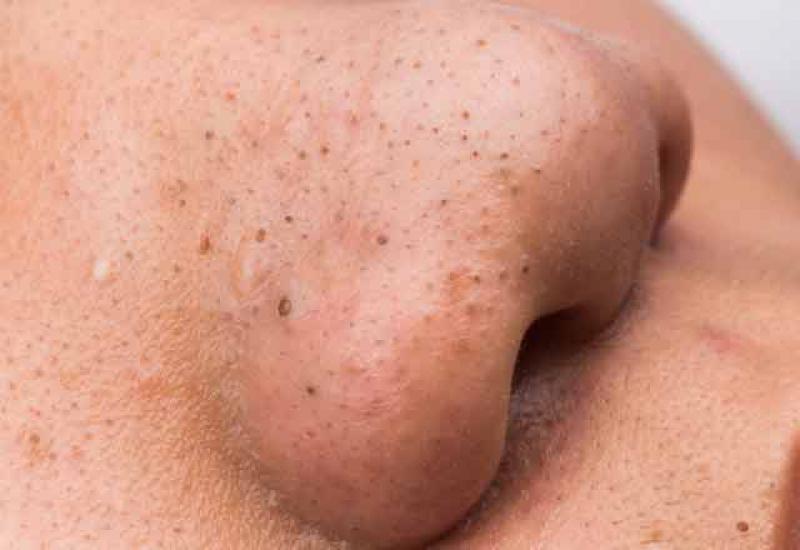 Siyah Nokta Nasıl Gider?