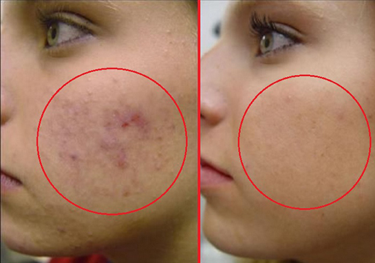 Siyah Nokta Neden Olur?