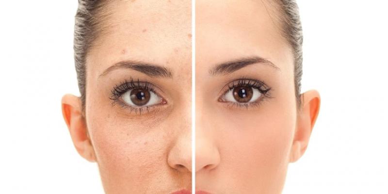 Siyah Nokta Temizleme Makinesi