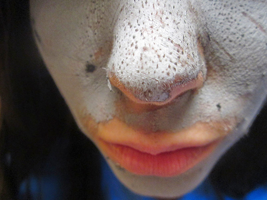 Siyah Nokta ve Gözenekler