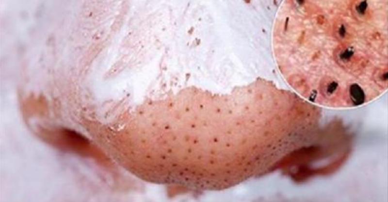 Tutkalla Siyah Nokta Uygulaması 